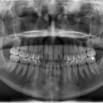 Are Pediatric Dental X-rays Safe?